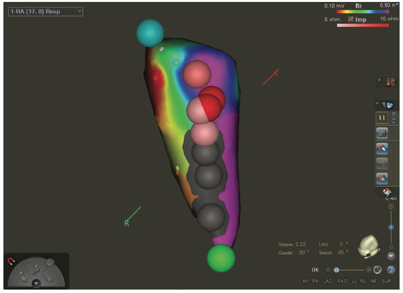 Knight Ablation Lesion Figure 2