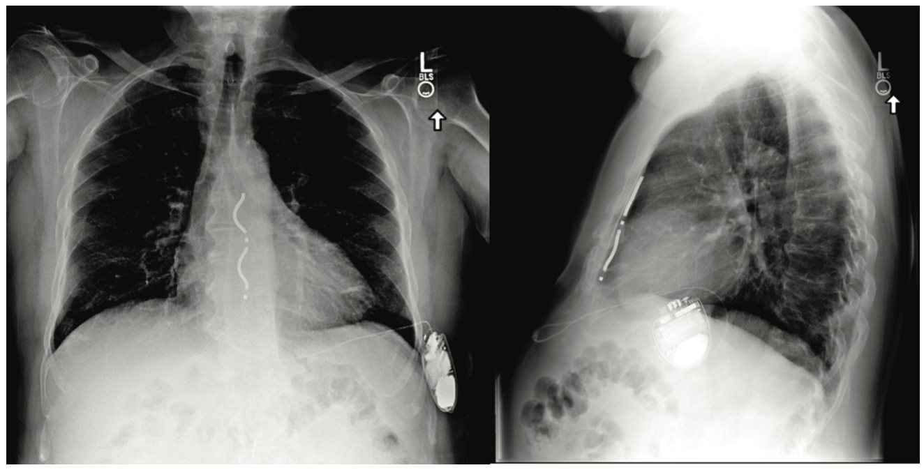 Knight Cardioverter-Defibrillator Figure