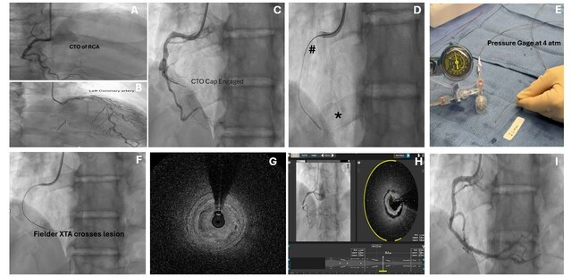 Figure. Coronary angiography showed CTO of the RCA
