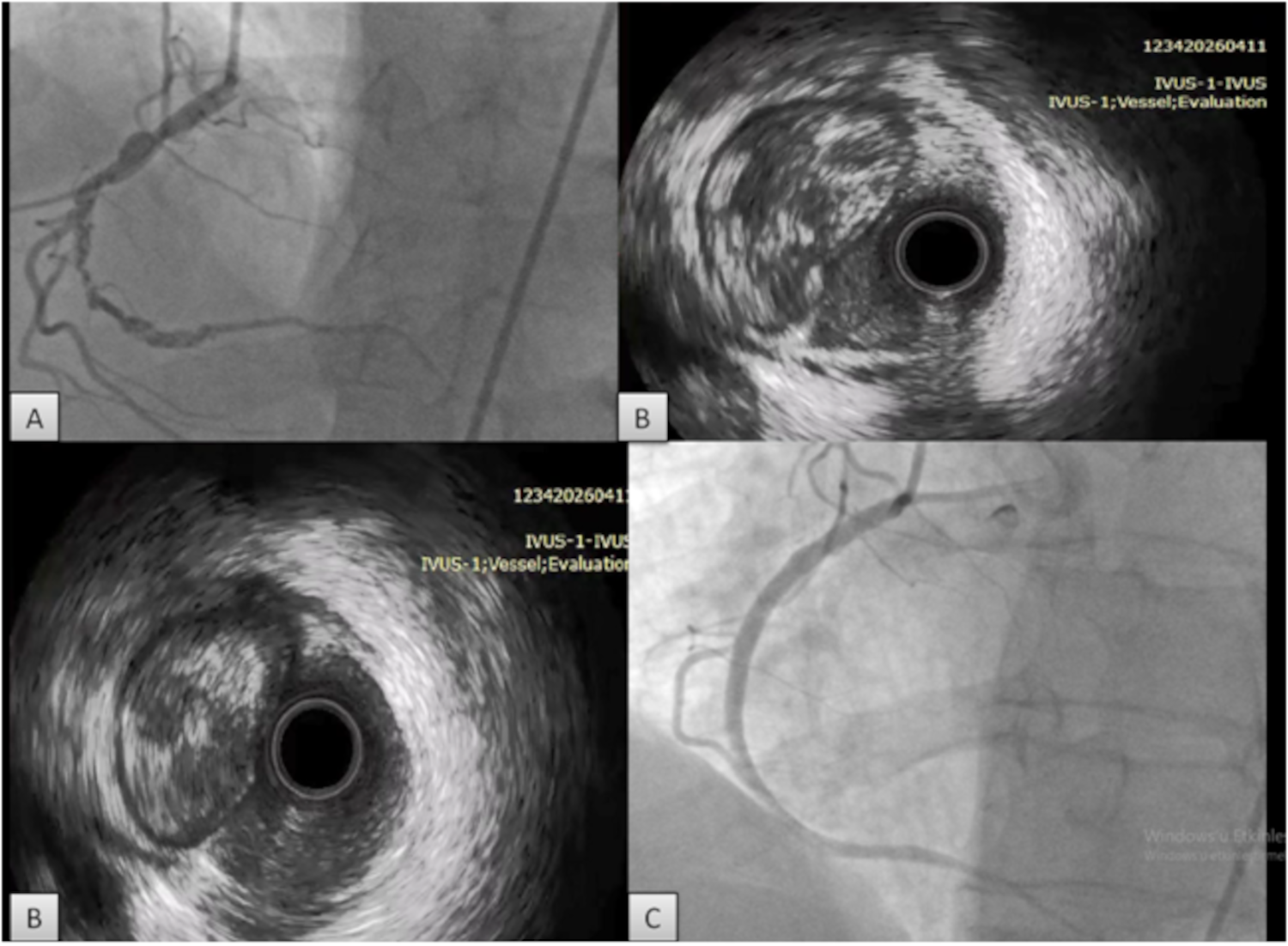 Figure. Coronary angiography
