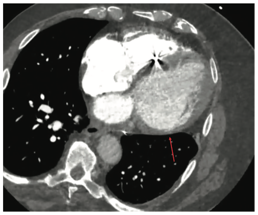 Kovacs Nonischemic Cardiomyopathy Figure 1