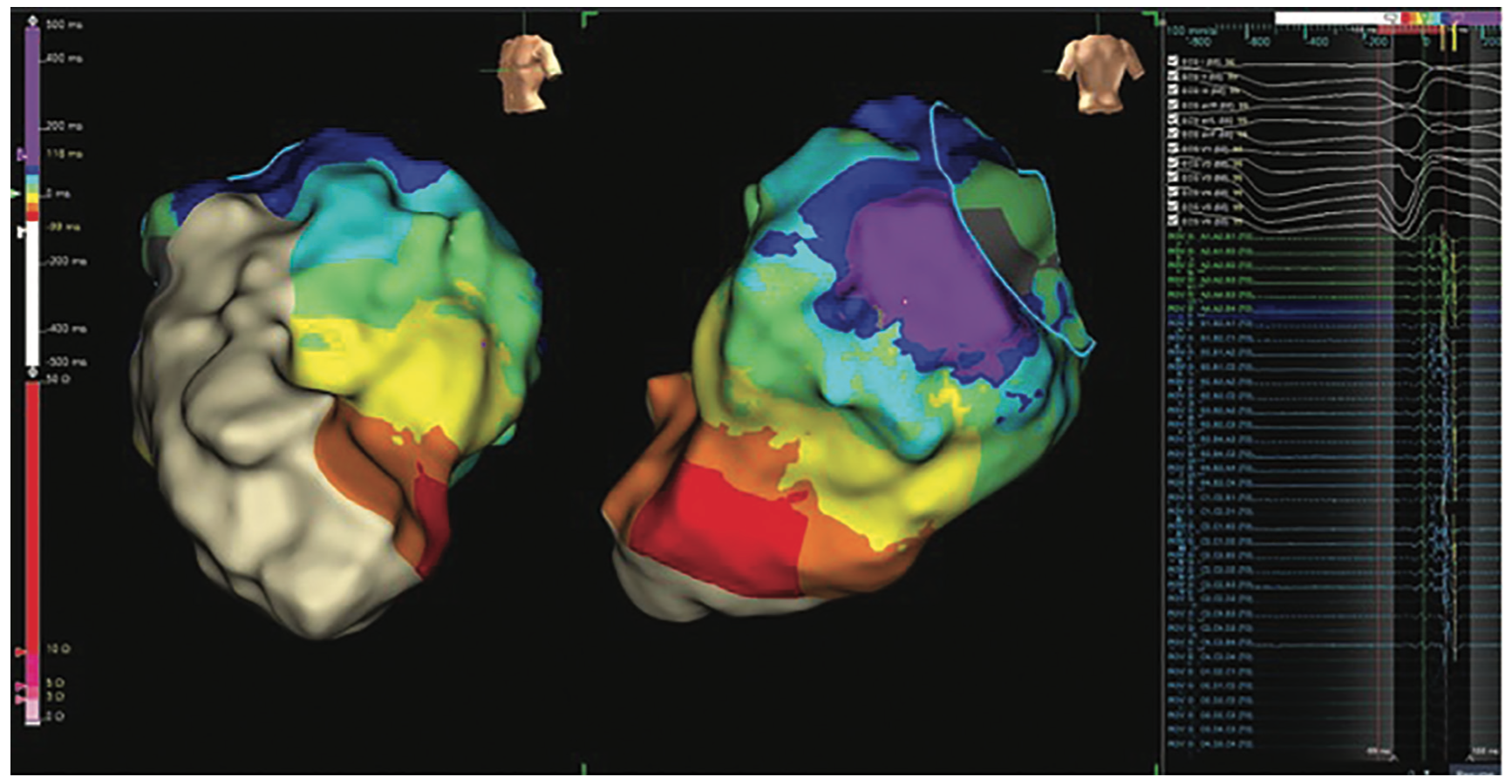 Kovacs Nonischemic Cardiomyopathy Figure 3