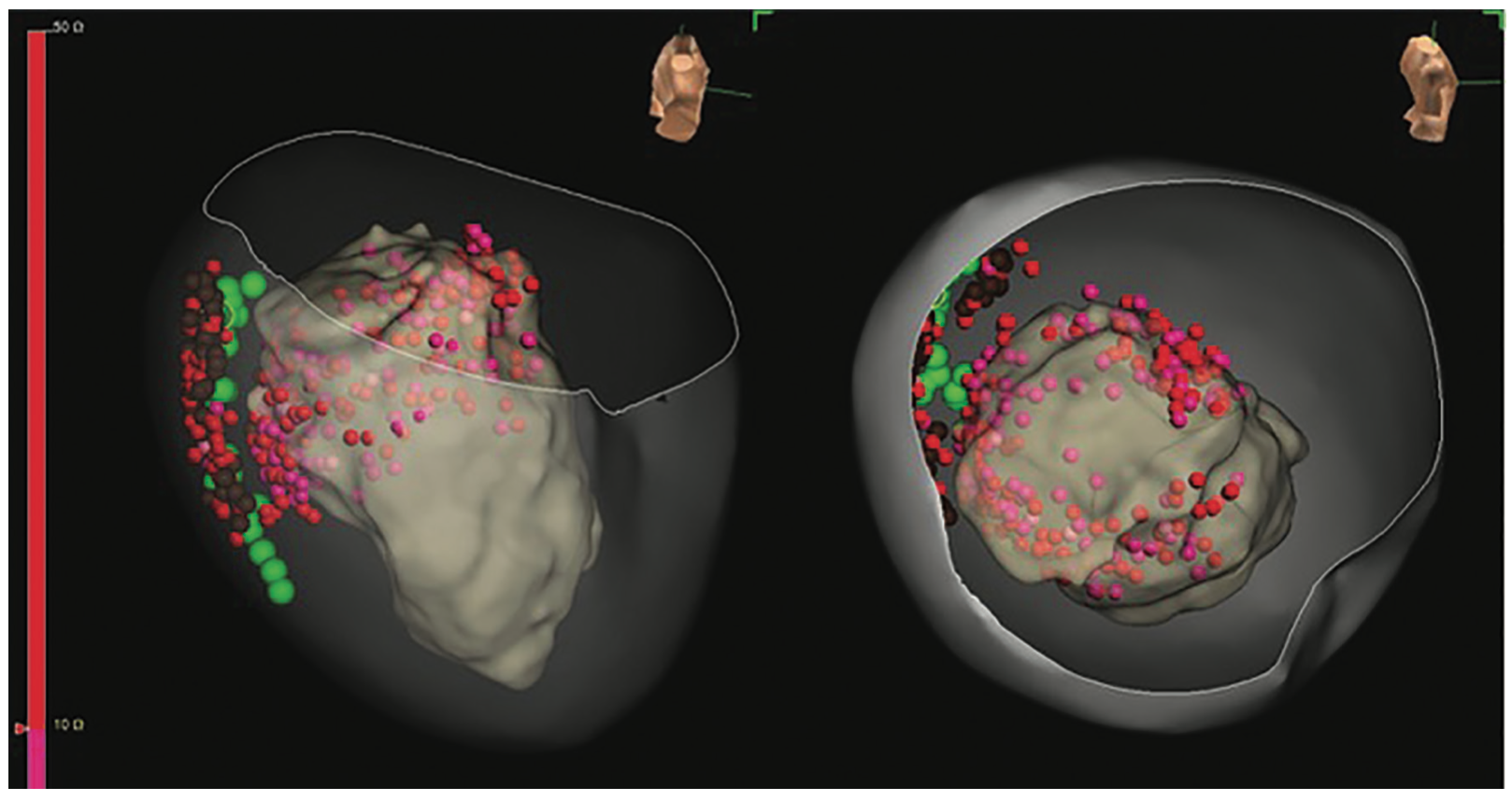 Kovacs Nonischemic Cardiomyopathy Figure 7