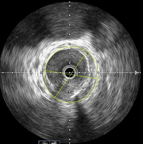 Figure 1. Intravascular ultrasound of left femoral artery.