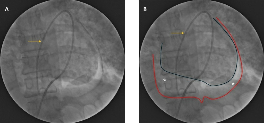Figure. Fluoroscopy image with a pigtail around the heart.  