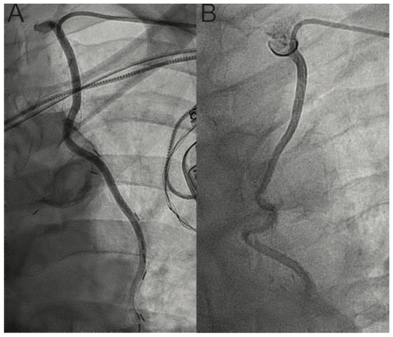 Kunnirickal Ipsilateral Figure 2