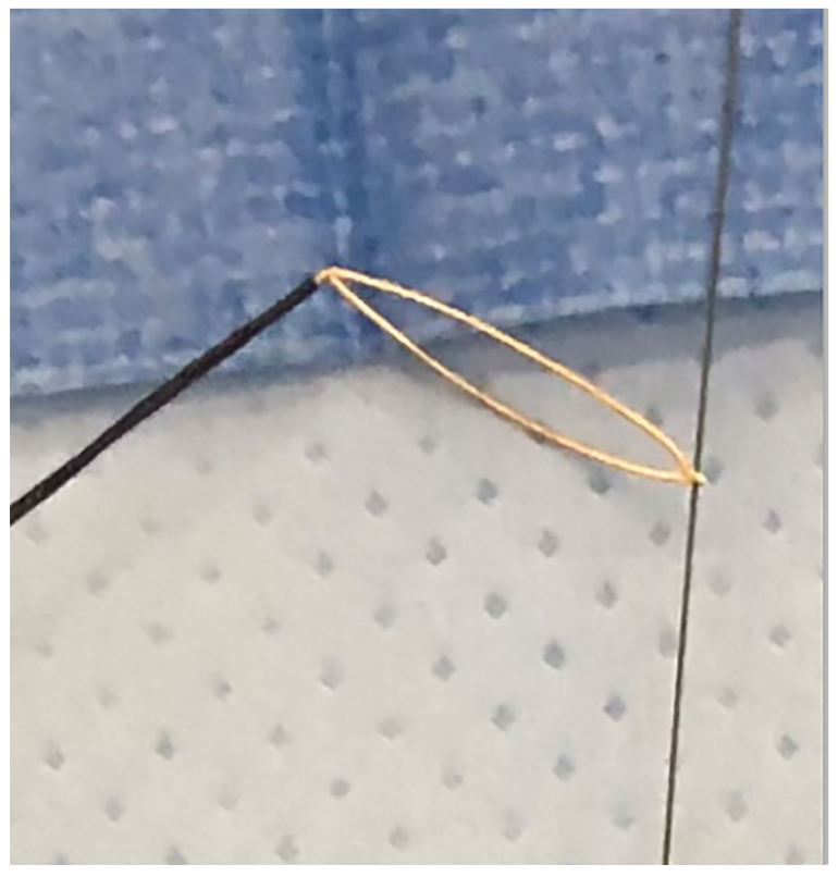 Kutkut Presnaring Technique Figure 1