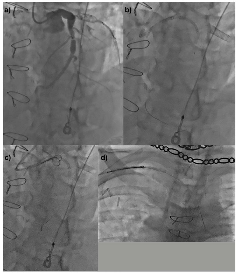 Kutkut Presnaring Technique Figure 3