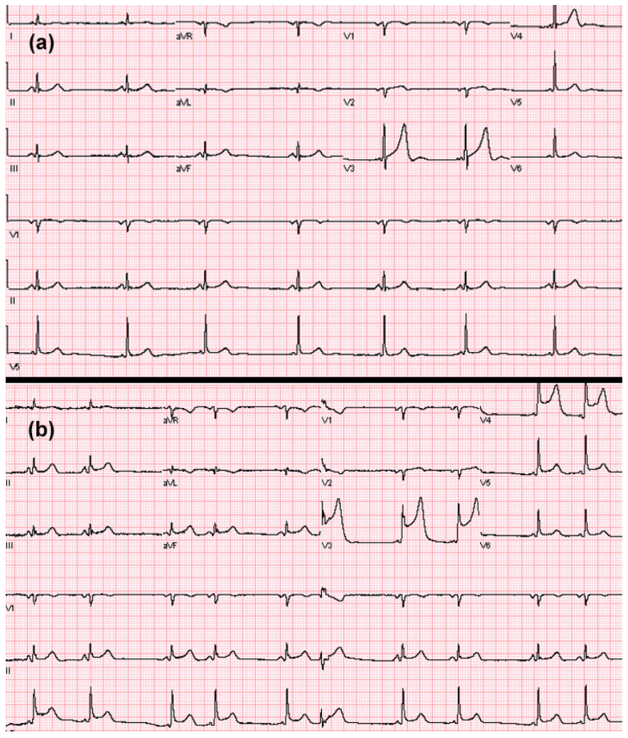 Kutkut STEMI Figure 1