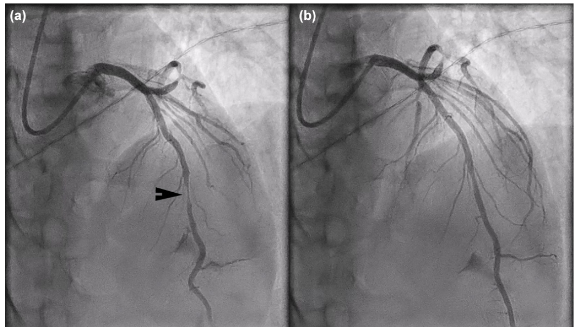 Kutkut STEMI Figure 2