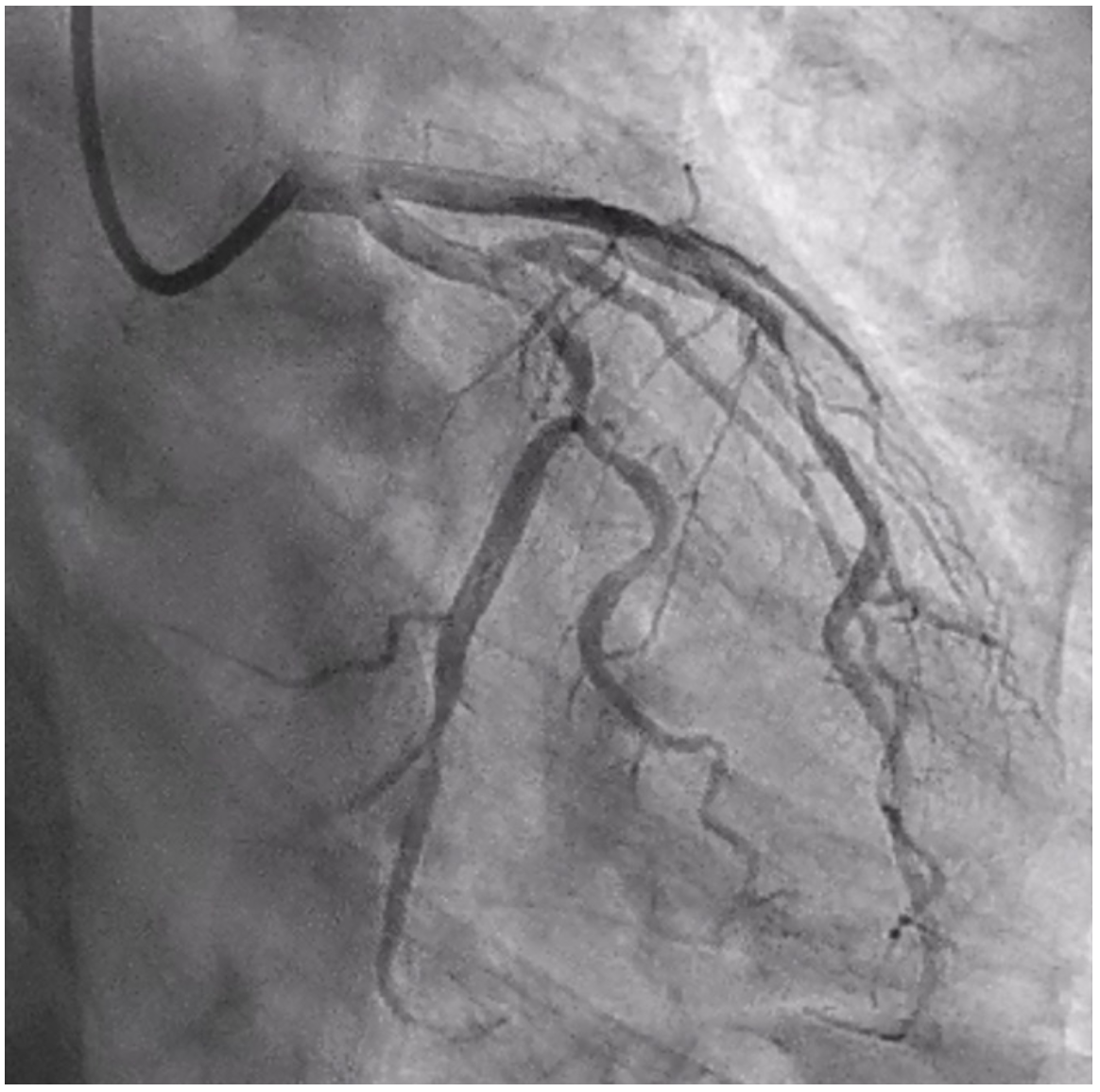 Kutkut STEMI Figure 3