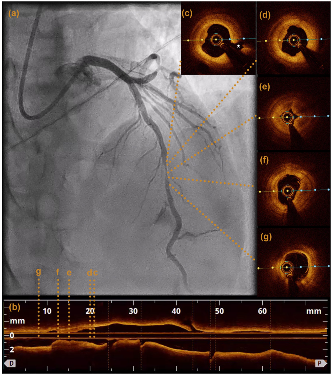 Kutkut STEMI Figure 4