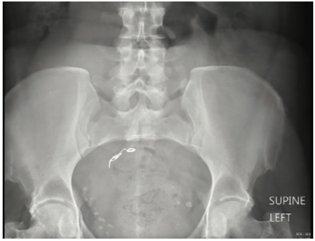 Kyaw Coil Embolization Figure 3