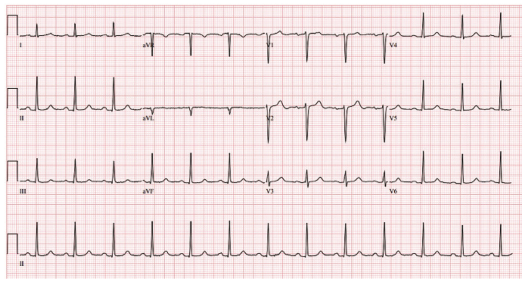 Kyaw Coil Embolization Figure 4