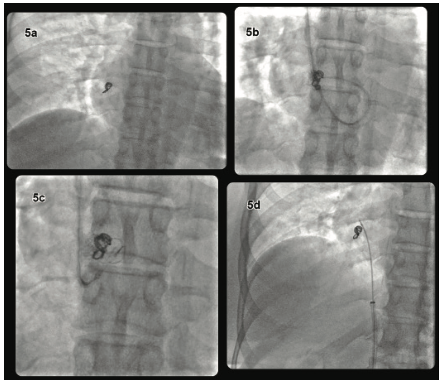 Kyaw Coil Embolization Figure 5