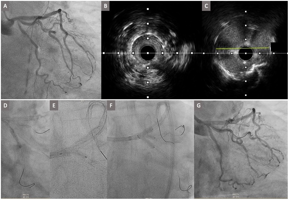 Figure 1. Complex LMCA trifurcation disease