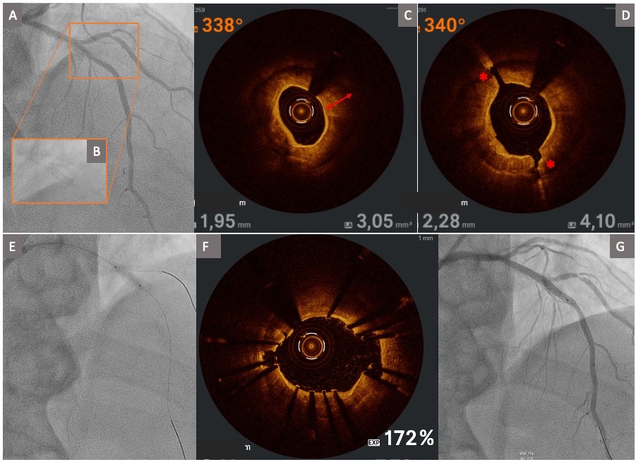 Figure 2. Severely calcified mid-left anterior descending artery lesion