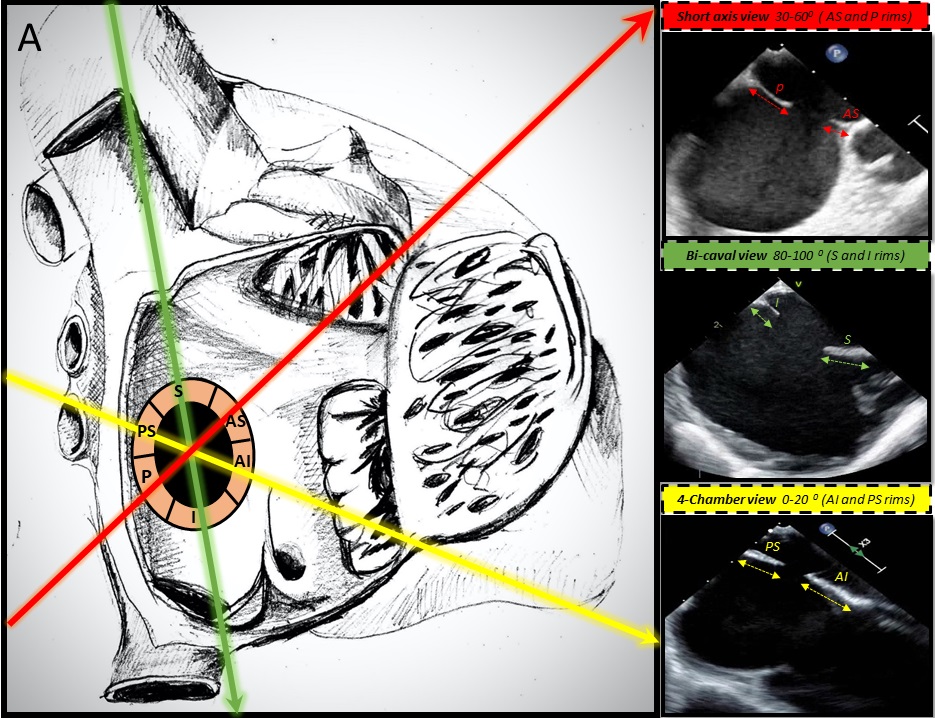 Figure 1. Transesophageal echocardiographic views demonstrating ASD rims. 