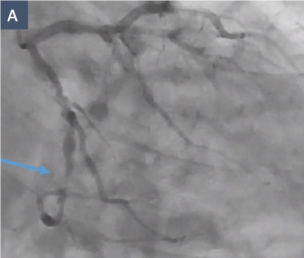 Figure A. Diagnostic Angiography. Caudal right anterior oblique projection showing a severe, heavily calcified stenosis of the distal left circumflex coronary artery (arrow).