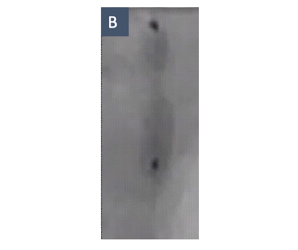 Figure B. Dogbone Balloon Aspect. Coronary angiogram showing a “dogbone” appearance after balloon inflation due to the heavily calcified stenosis.
