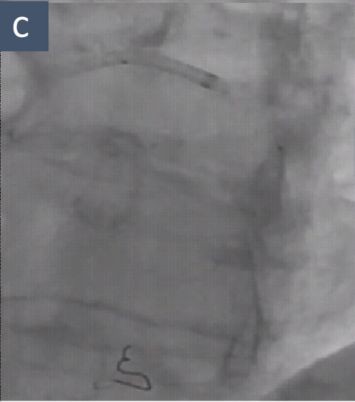 Figure C. First Balloon Entrapment and Rupture. The entrapped 2.5 × 15 mm NC balloon showing shaft elongation during attempted retrieval.