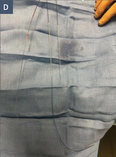 Figure D. Snare Retrieval of Ruptured Balloon. A 4 mm One Snare (Merit Medical) grasping and retrieving the distal portion of the fractured balloon.