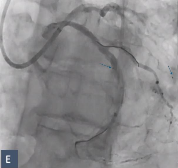Figure E. Retained Radiopaque Markers. The radiopaque markers, which separated from the balloon shaft, remained within secondary collateral vessels and were not retrieved. The first marker was entrapped in a secondary branch (right arrow) and the second marker (left arrow) was entrapped in contact with the calcified nodule with no resulting flow compromise.