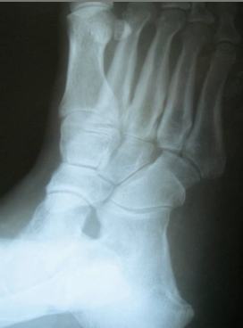 Plain film radiographs may note medial subluxation of the fourth metatarsal on the cuboid, which can represent the presence of hypermobility.