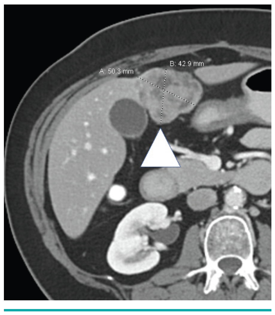 Leiomyosarcoma Metastasis in the Liver Yevich Fig 1