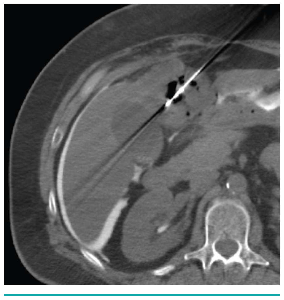 Leiomyosarcoma Metastasis in the Liver Yevich Fig 3