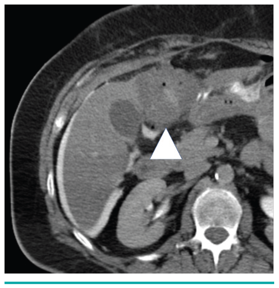 Leiomyosarcoma Metastasis in the Liver Yevich Fig 4