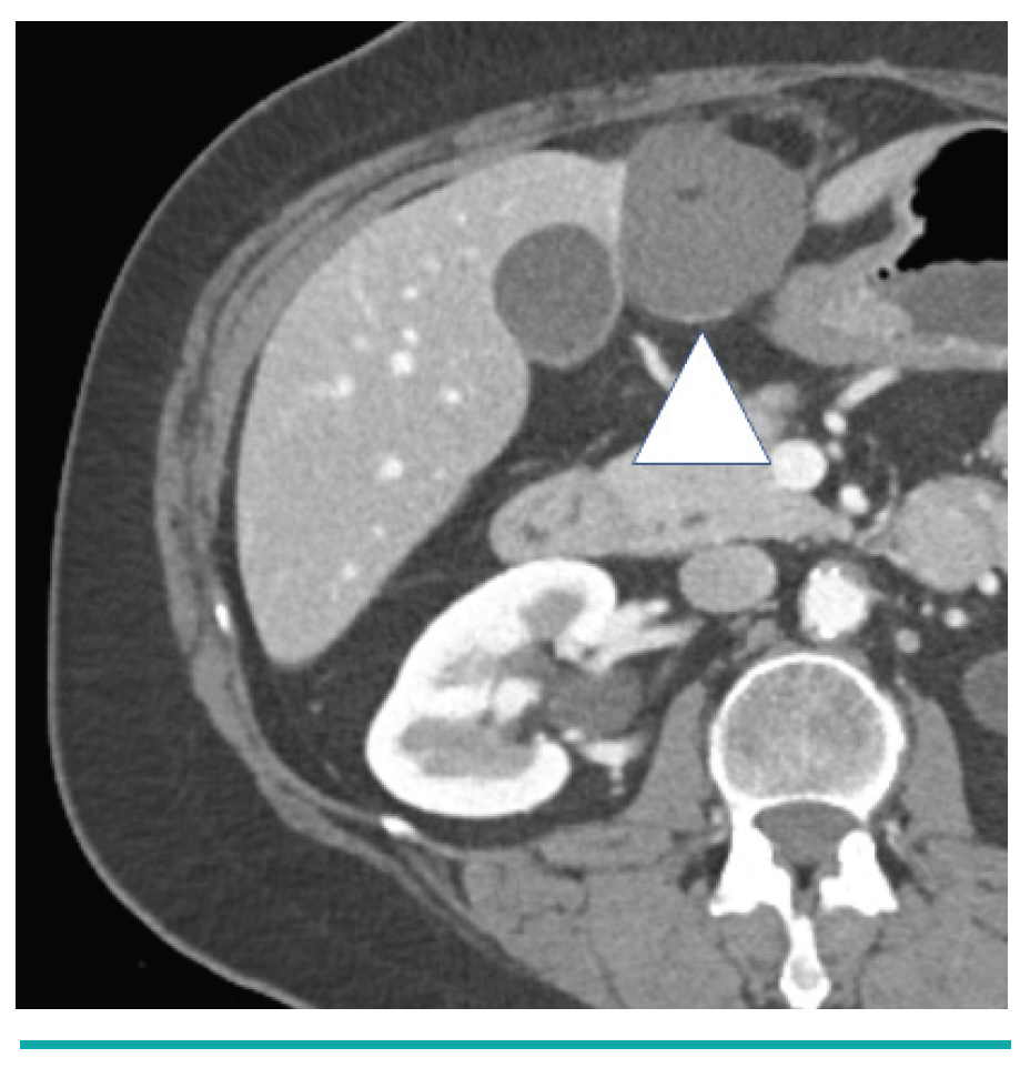 Leiomyosarcoma Metastasis in the Liver Yevich Fig 5
