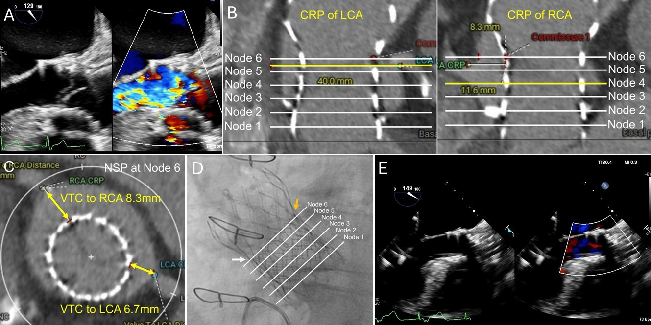 Figure. Transesophageal echocardiography of flail left coronary cusp