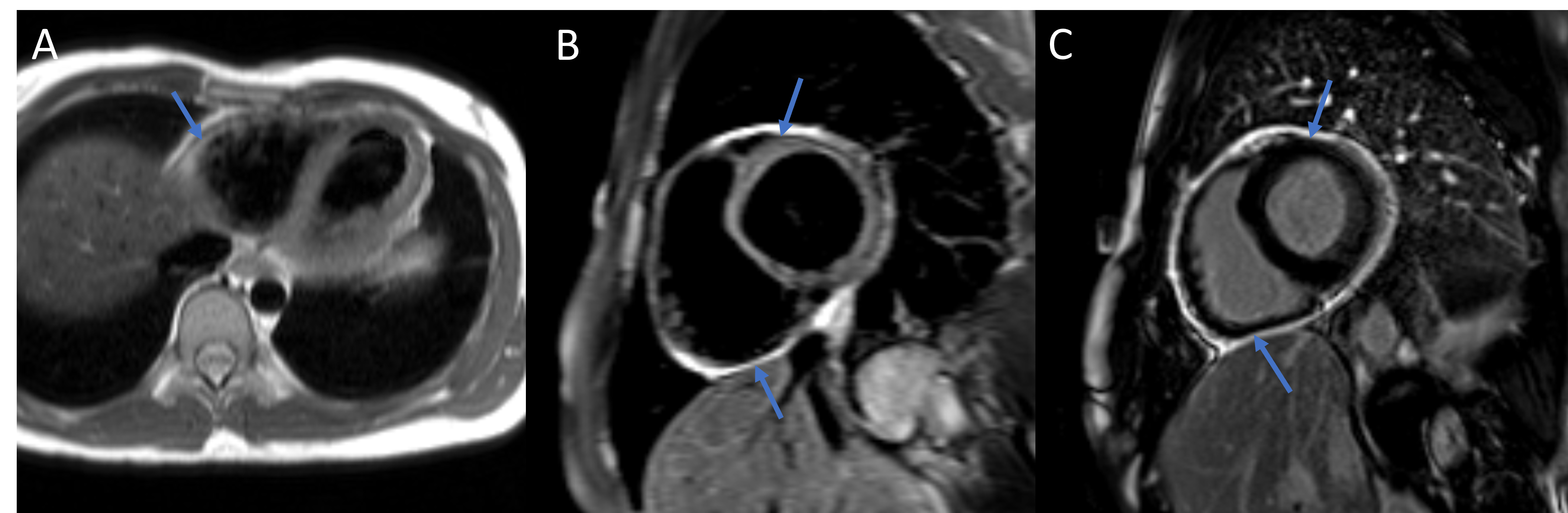 Figure 2.  Cardiac magnetic resonance imaging showed mild pericardial thickening