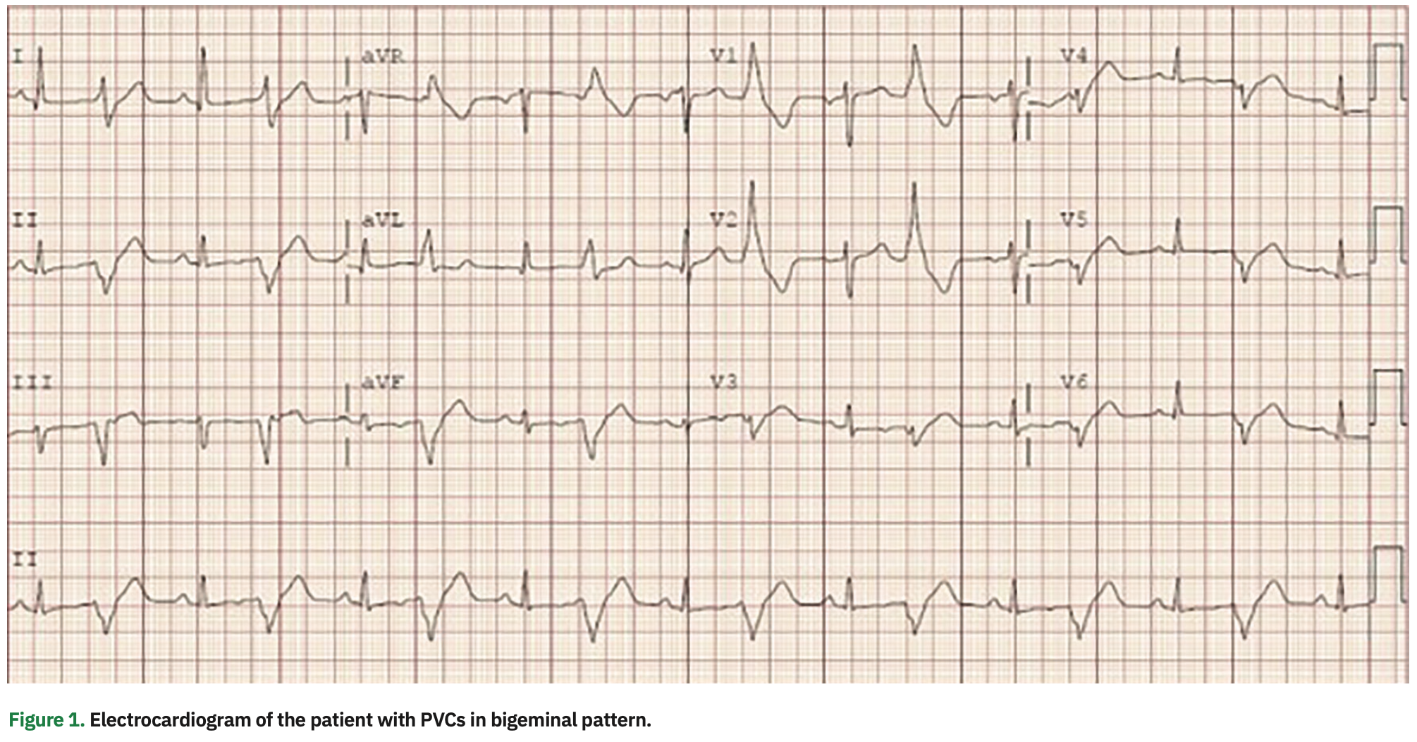 Leyton Premature Ventricular Contractions Figure 1