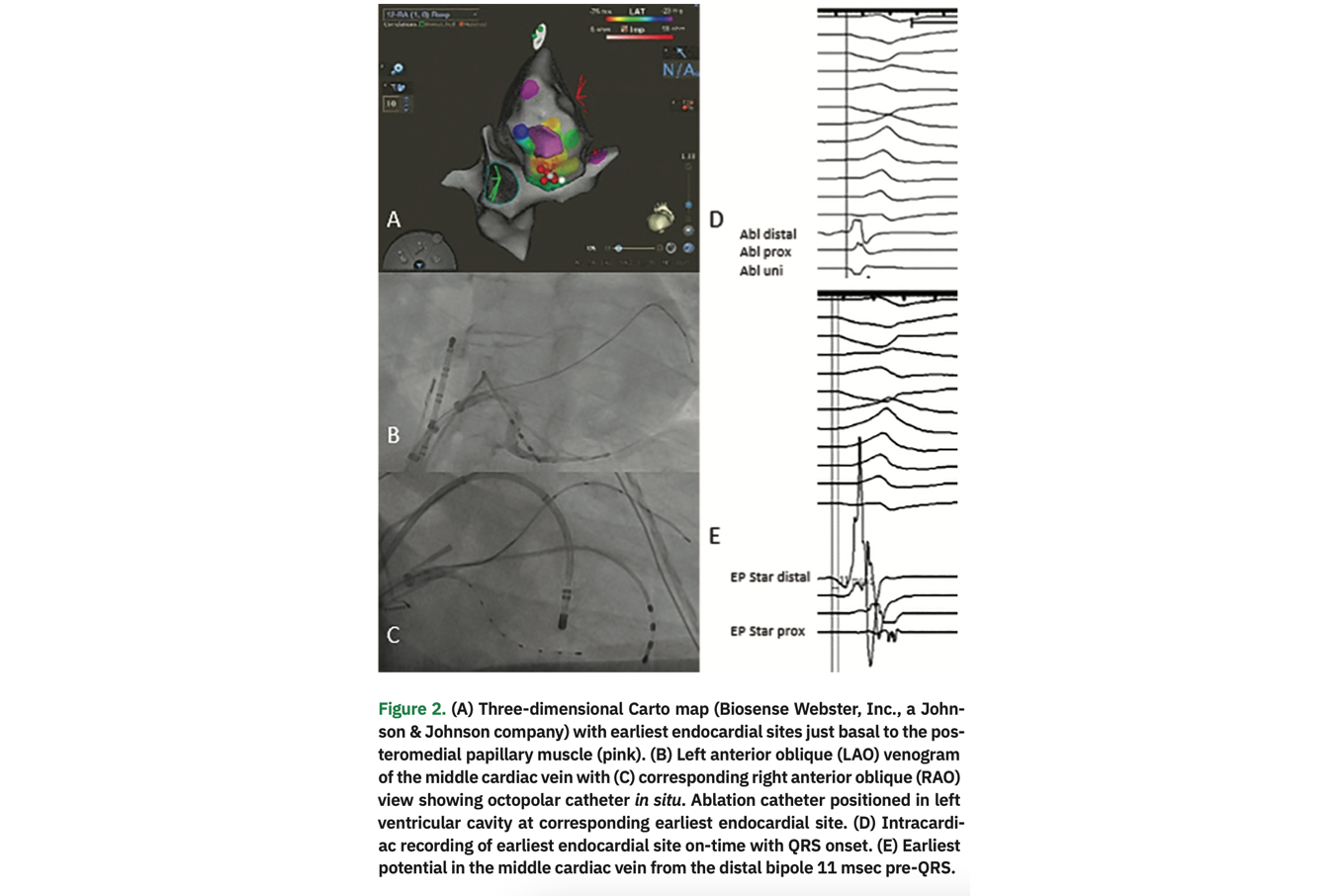 Leyton Premature Ventricular Contractions Figure 2