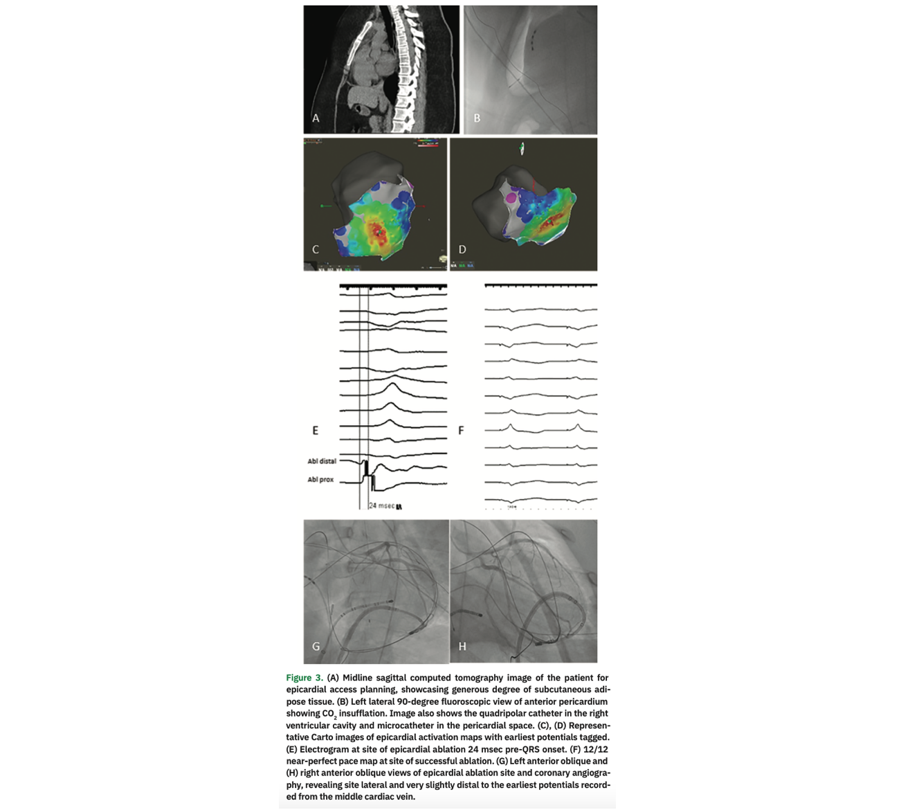Leyton Premature Ventricular Contractions Figure 3
