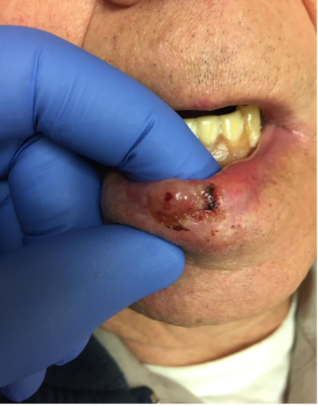 basal cell carcinoma