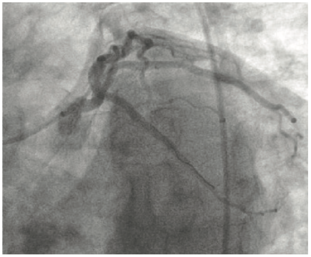 Lichaa Guide Catheter Figure 14