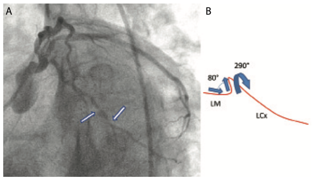 Lichaa Guide Catheter Figure 3