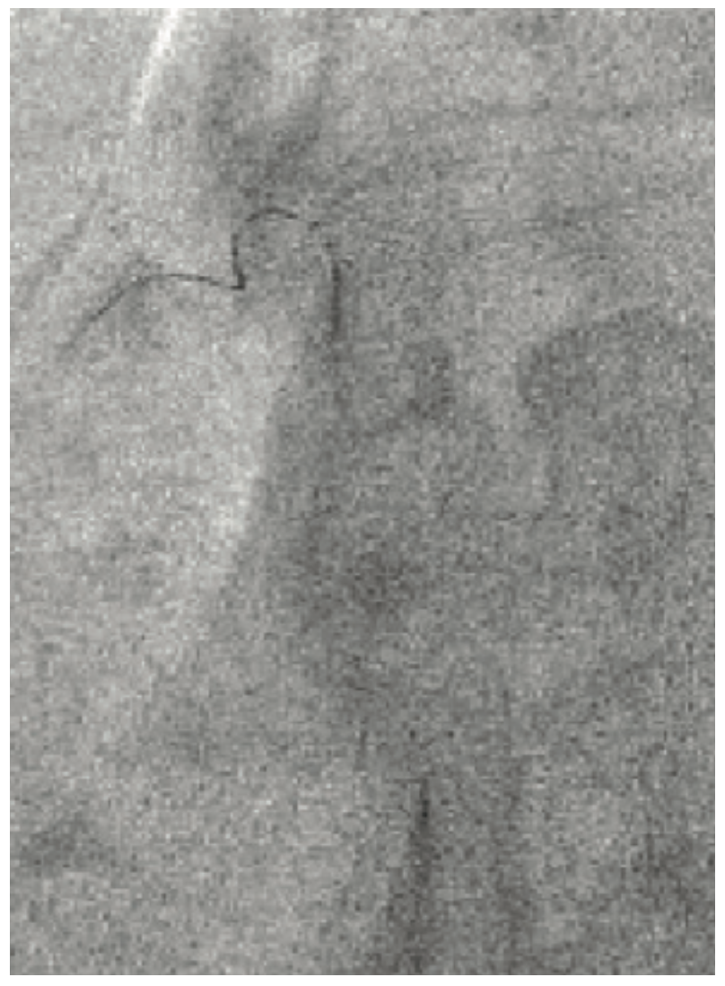 Lichaa Guide Catheter Figure 5