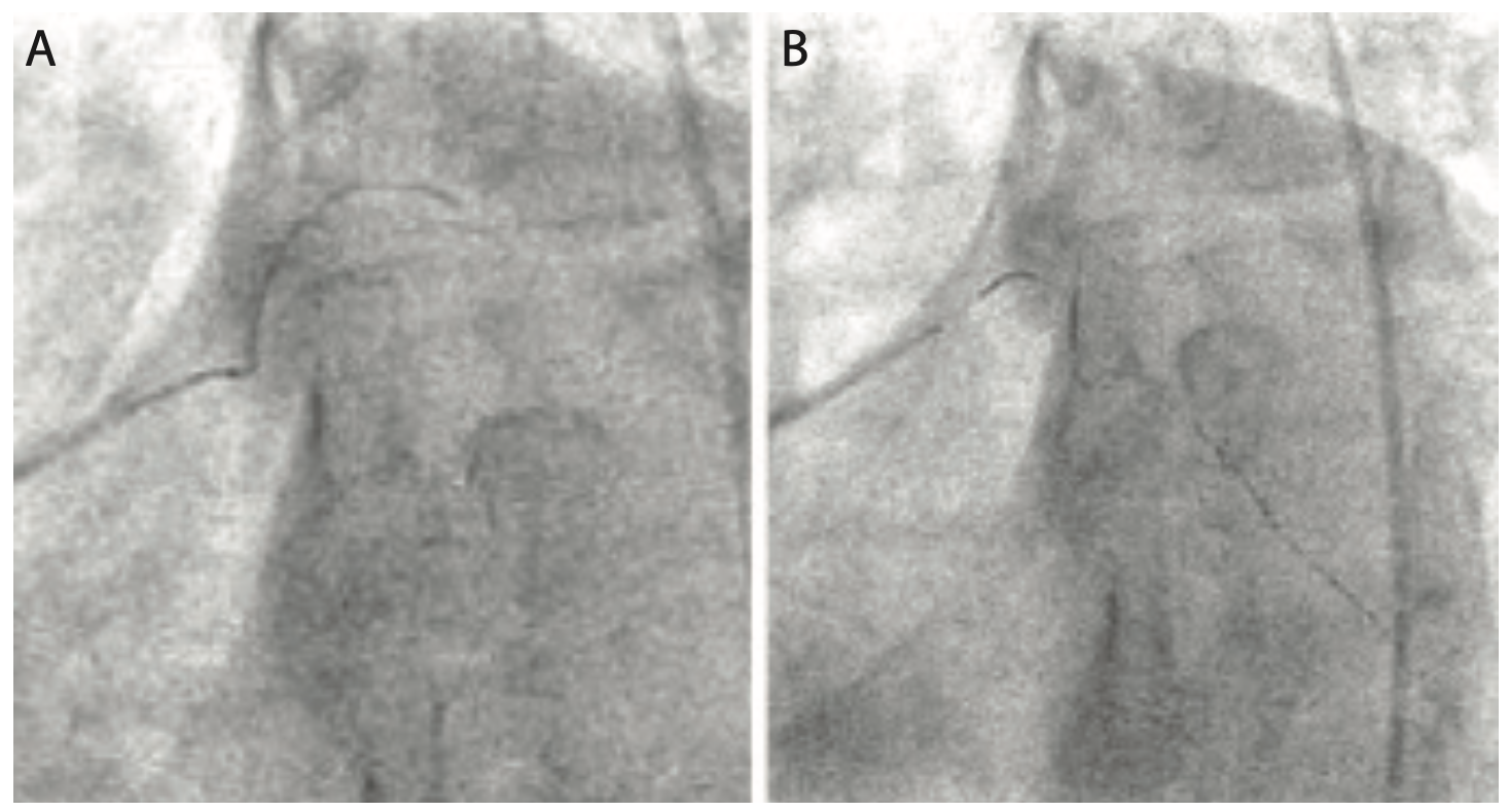 Lichaa Guide Catheter Figure 7