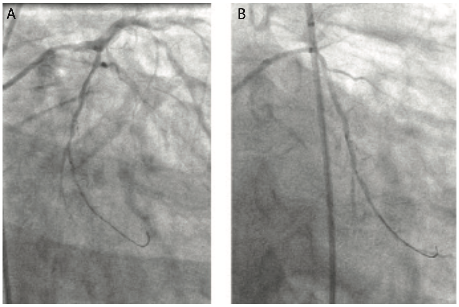 Lichaa Guide Catheter Figure 8