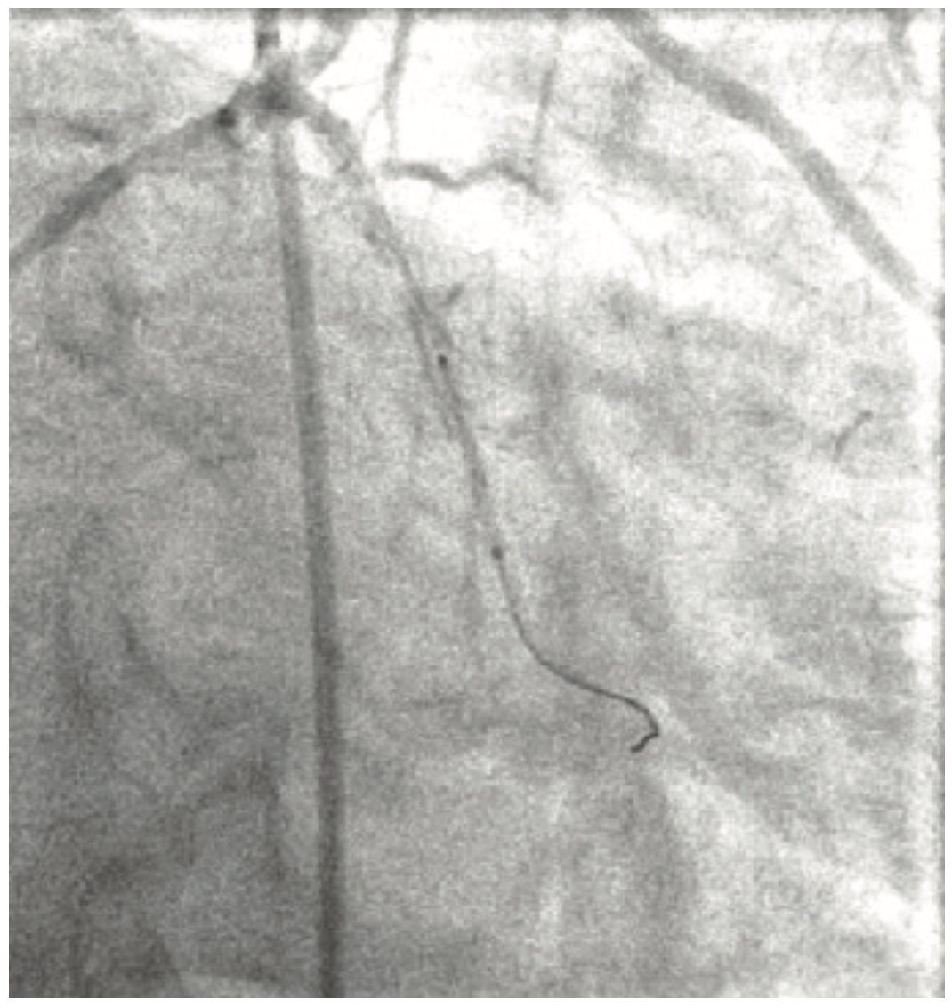 Lichaa Guide Catheter Figure 9