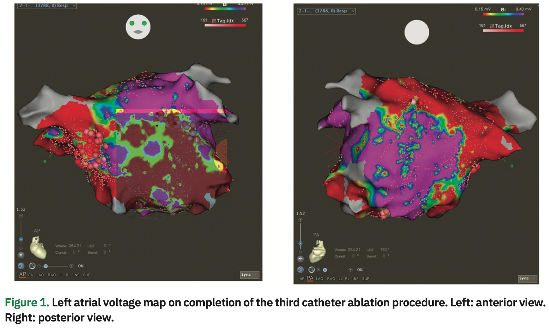 Lippman AFib Figure 1