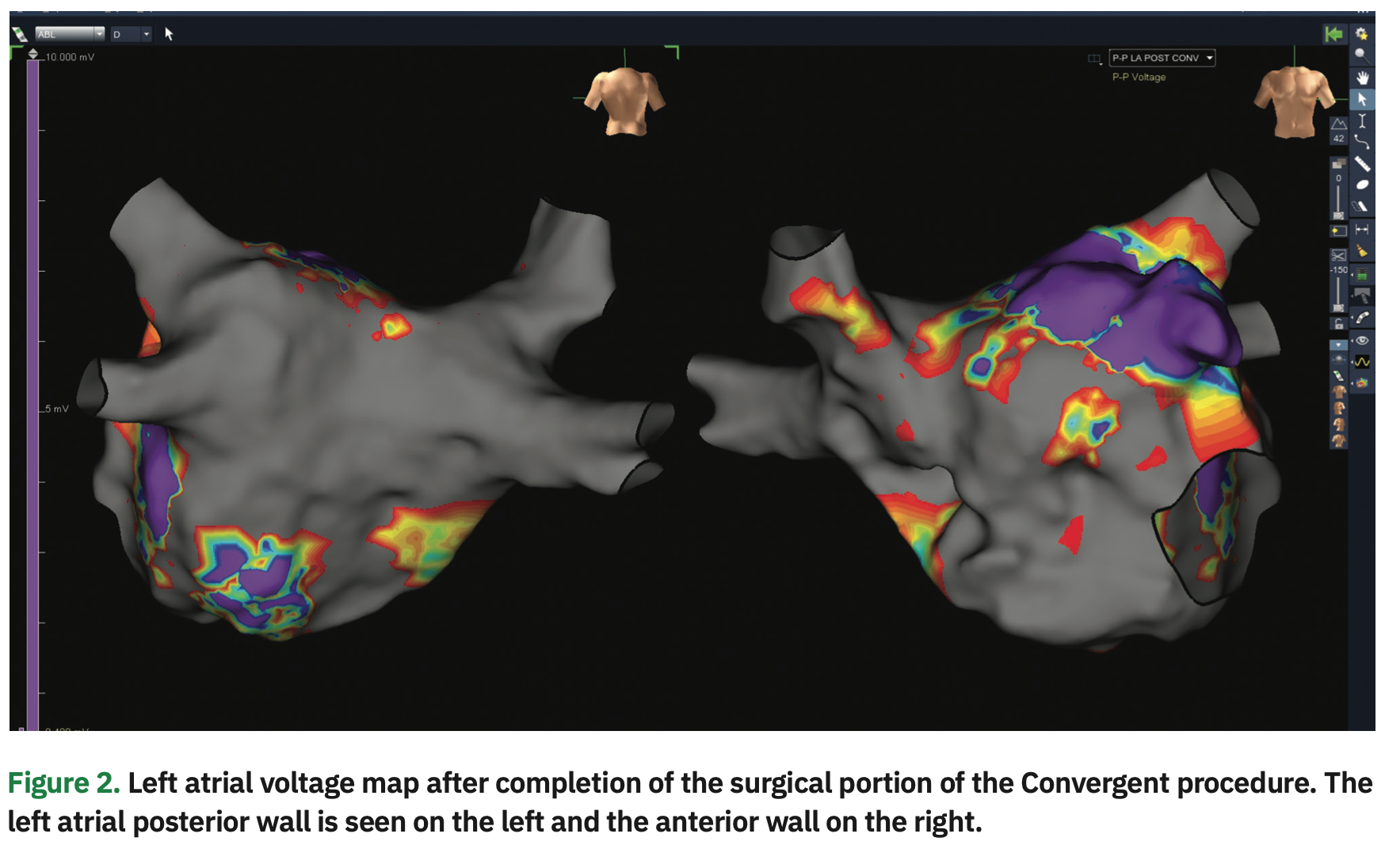 Lippman AFib Figure 2