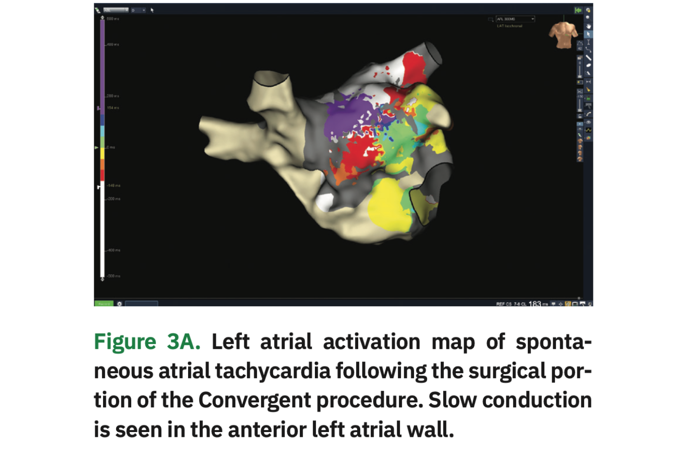 Lippman AFib Figure 3A