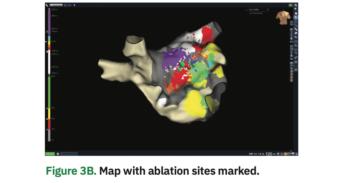 Lippman AFib Figure 3B