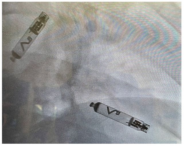 Lo Cardiac Pacing Figure 1