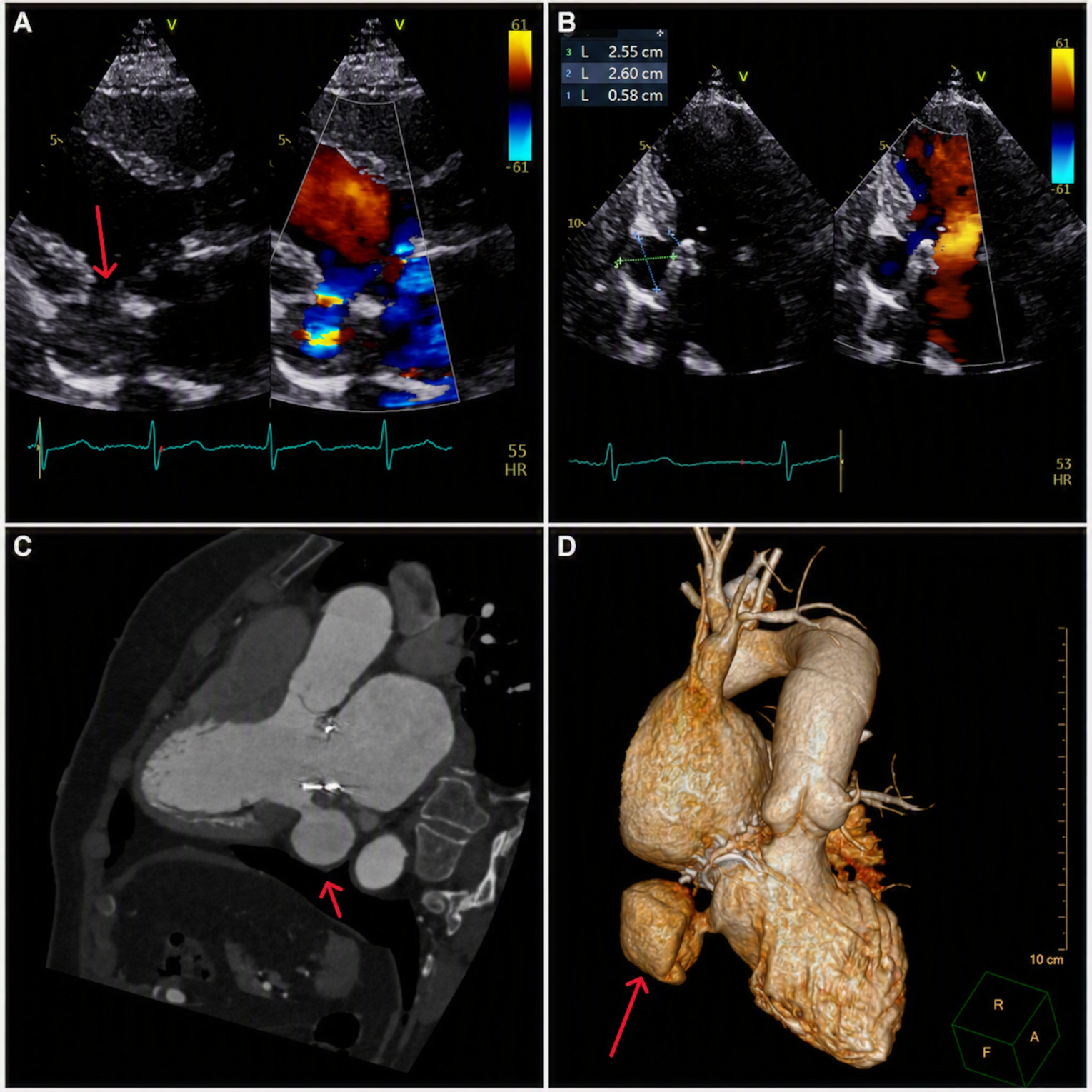Figure 1. Multimodality imaging of a post-surgical submitral LV pseudoaneurysm.